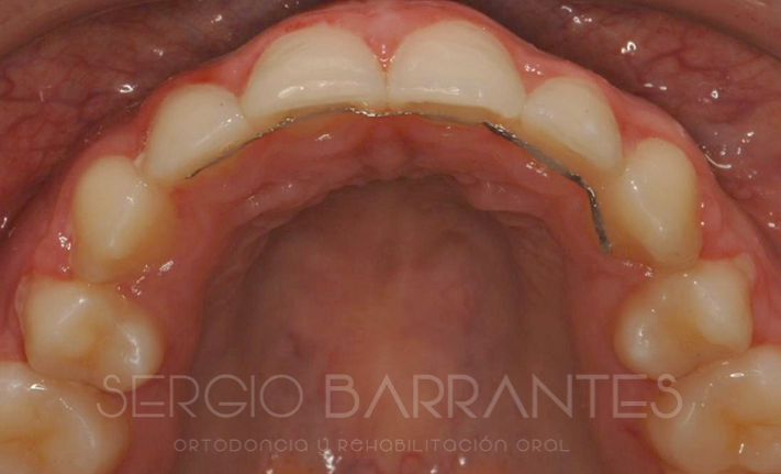 Fases de la ortodoncia y duración del tratamiento con Brackets